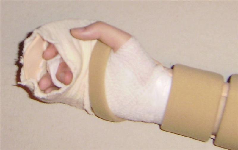 The new splint